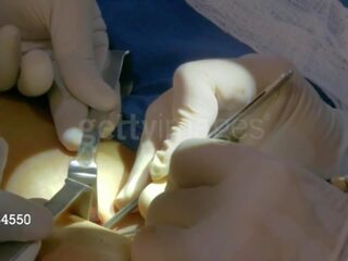 Aj alltuulekülg pärit wwe saab tema third rind implant: tasuta x kõlblik video 8e
